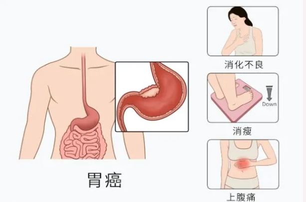魔高一尺，道高一丈：胃腸鏡—消化道早癌克星