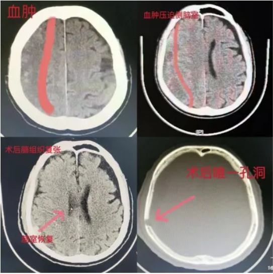 【健康科普】警惕老年人的沉默殺手，認識慢性硬膜下血腫