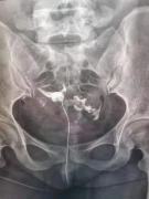 臨滄市中醫(yī)醫(yī)院已開展子宮輸卵管造影檢查！